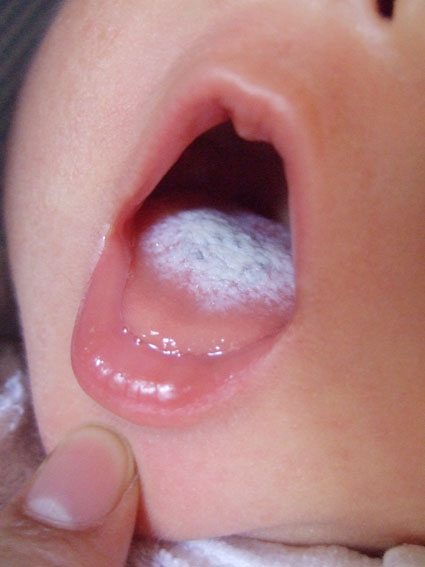 赤ちゃん 舌 が 白い